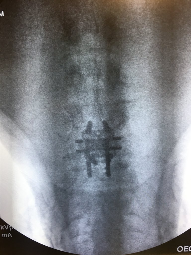 trentnorthcutt's tweet photo. It’s a great day! Helping people get better. #back2good @AuroraSpine #zipdone #Spine https://t.co/kCIT72M29f