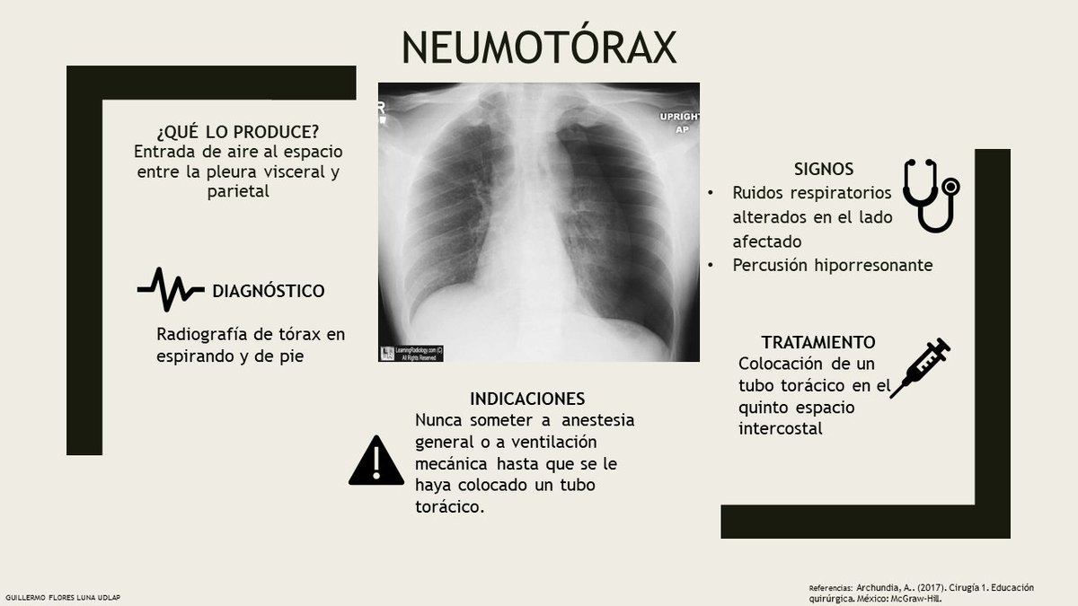 guillermofluna's tweet photo. @abarcvs #Infograma #Actividad #SimuVale #Campos #Neumotórax #Minimalismo @Creative_Nurse @FOAMexico @ChuletasMedicas Un neumotórax se puede complicar a uno a tensión comprometiendo la función cardíaca y pulmonar. https://t.co/jBpGUGvk9S