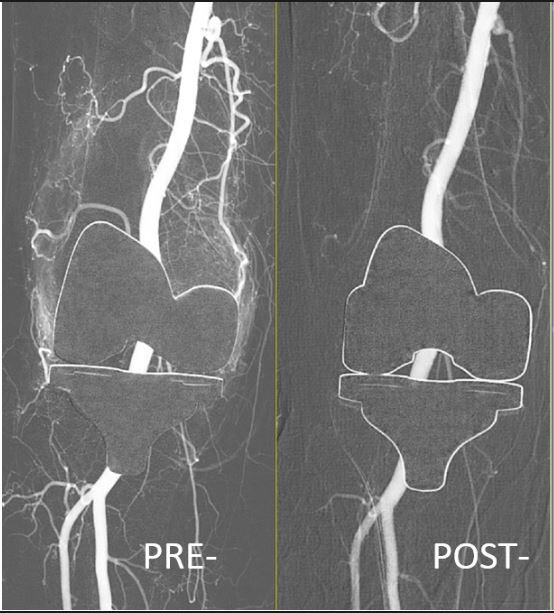 #GAE Geniculate artery embolization for recurrent hemoarthosis. Works every time!!!#IRad