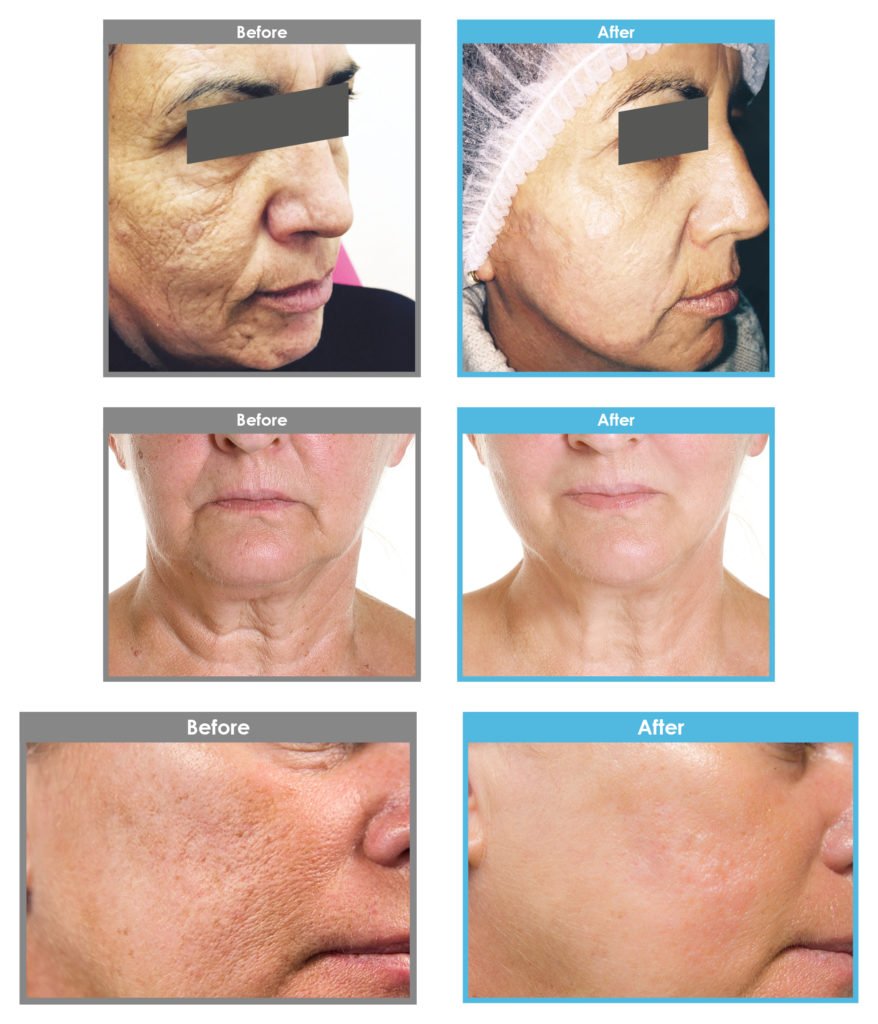 Use Plenhyage for:
 Deep tissue regeneration. To improve skin elasticity and hydration. The care of  skin damaged by the sun or by scarring (acne).
vida-aesthetics.com
 #biorevitalizer #fillers #aesthetictreatments #skintreatments #cosmetictreatments #vidaaesthetics