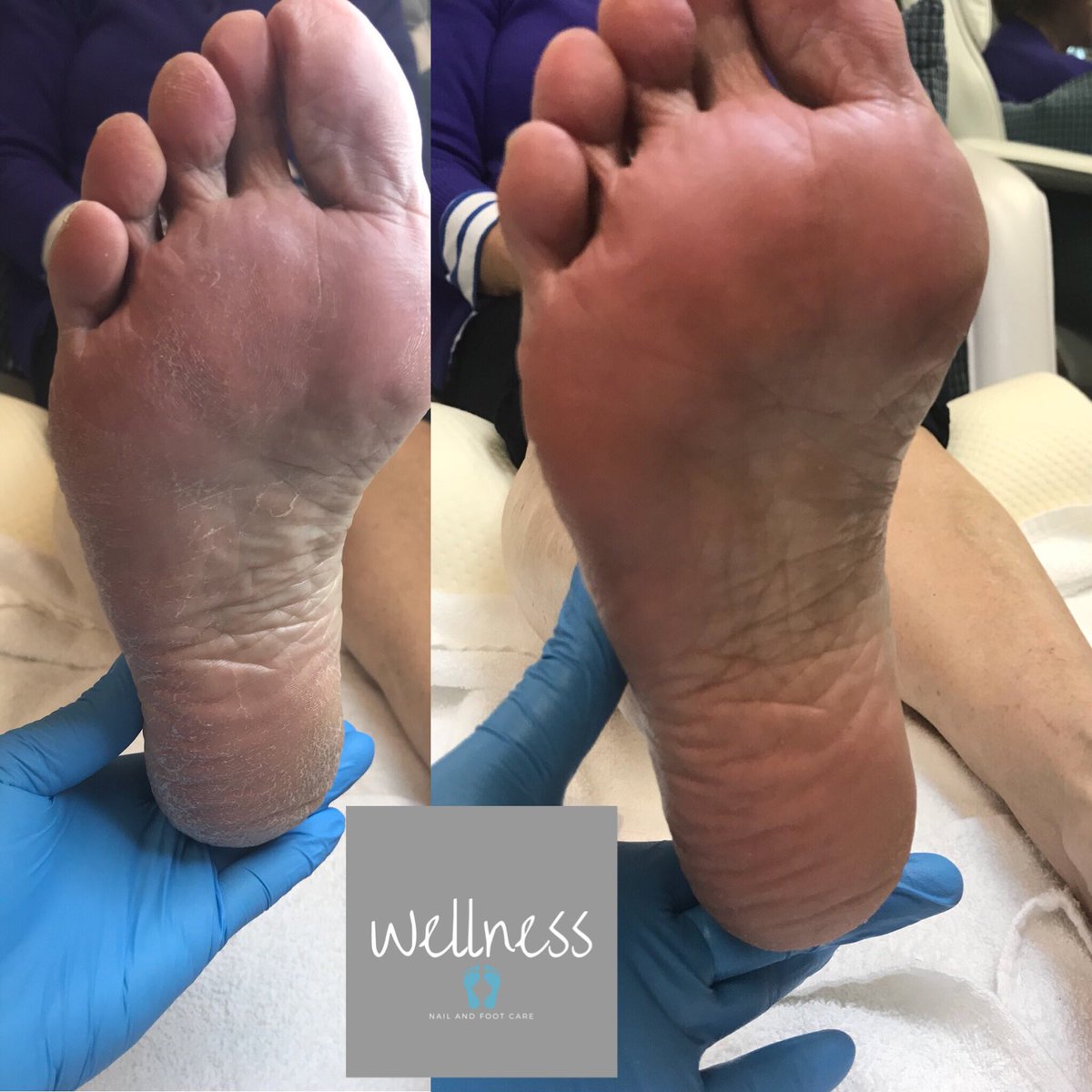 WellnessFoot tweet picture