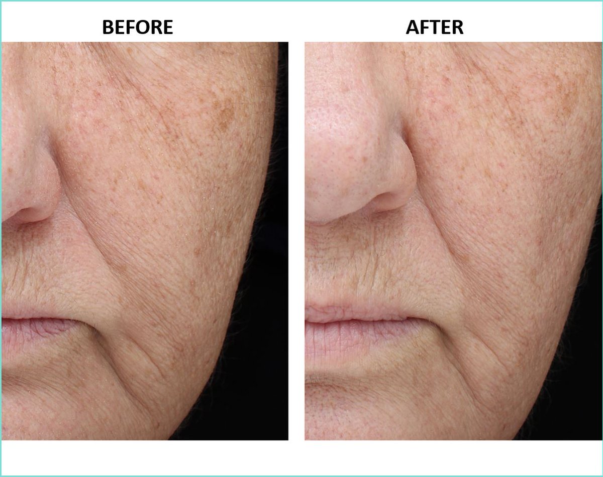 nowmi_treatment's tweet image. This is a 64-year-old woman who underwent 6 weekly NowMi treatments.  Each treatment took her 5 minutes.  As you can see, there was a marked reduction of fine lines around the eyes and brown spots! For more results visit
ow.ly/9C3c30jDZu6