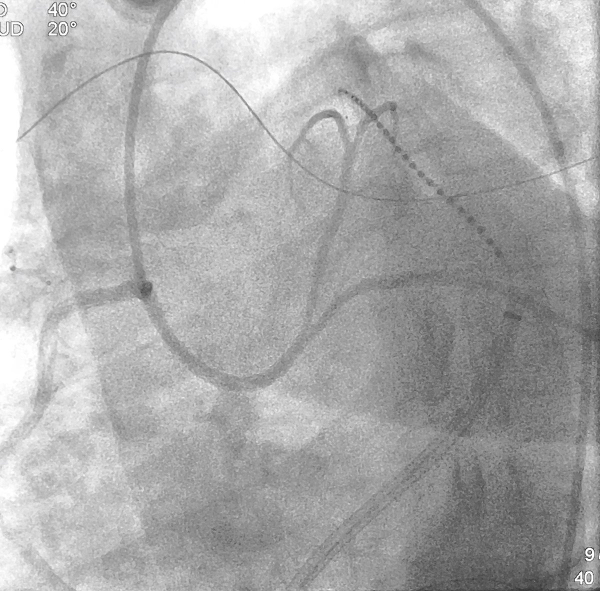 DrRoderickTung's tweet photo. Large inaccessible triangle of LV summit with anomalous left from right coronary cusp, referred for robotic endoscopic approach. #ablateVT #anatomy #EPrules https://t.co/ysq5lkxgoe