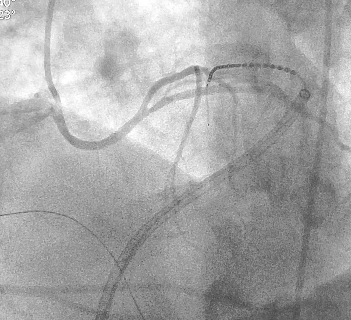 DrRoderickTung's tweet photo. Large inaccessible triangle of LV summit with anomalous left from right coronary cusp, referred for robotic endoscopic approach. #ablateVT #anatomy #EPrules https://t.co/ysq5lkxgoe