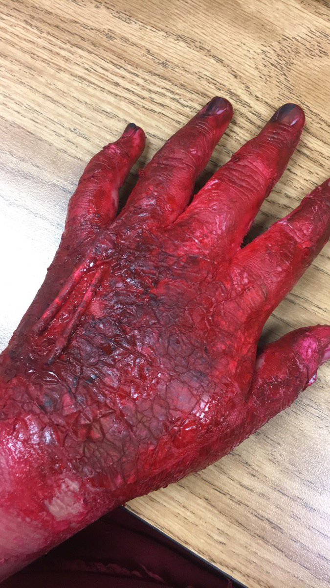 santiagodiana06's tweet photo. #RHSBMS 4th degree Burn @valaree_kaiser @pedantic_loner https://t.co/b75b1Jq5TB