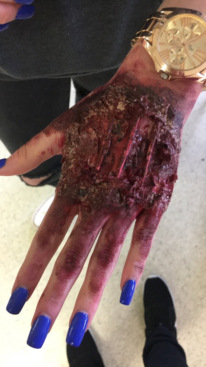 santiagodiana06's tweet photo. #RHSBMS 4th degree Burn @valaree_kaiser @pedantic_loner https://t.co/b75b1Jq5TB