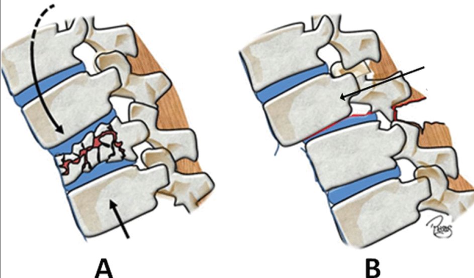 ASNRographics's tweet image. The classification of #spinal trauma has been radically revised with a new international consensus.  If you want to speak the same language as your surgeons, read this Neurographics article: bit.ly/2JmLkWY #neurorad #spinerad