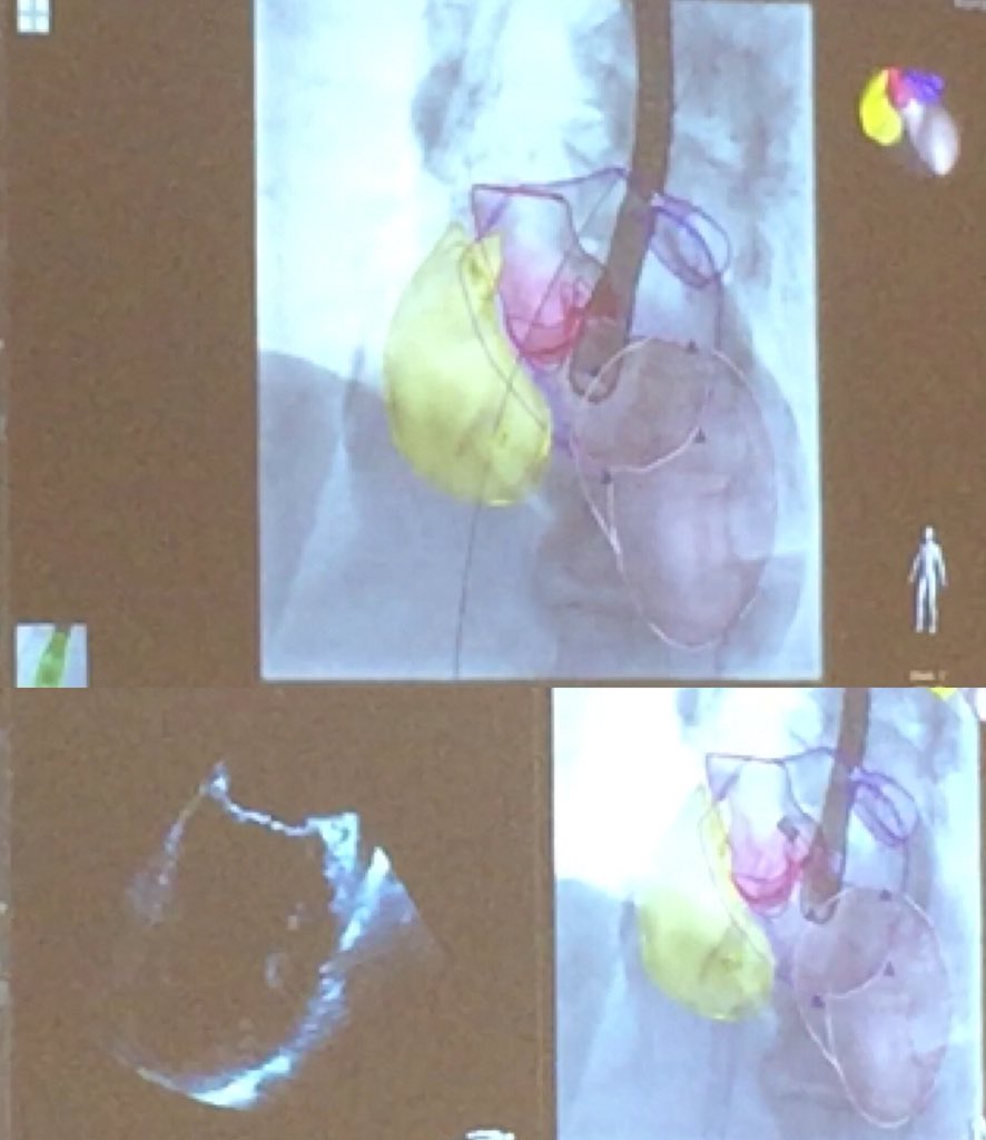 isabel_azevedo_'s tweet image. The future is here #fusionimaging #echointhecathlab #echocardiography #HEART_TEAM