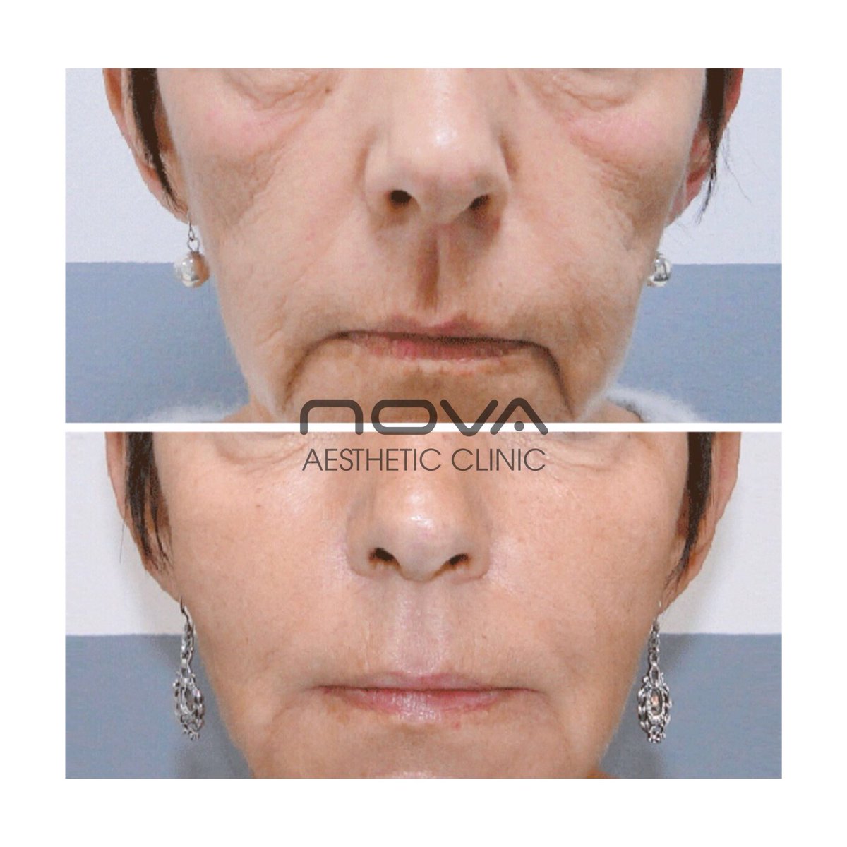 ✨DERMAL FILLERS at Nova ✨ We can’t get over this before and after! 😍😱 Nova’s expert doctors are recognised leaders in the art of dermal filler application, and utilise exclusively top brands fillers, certified and FDA approved 👌🏼 #greenwich #filler