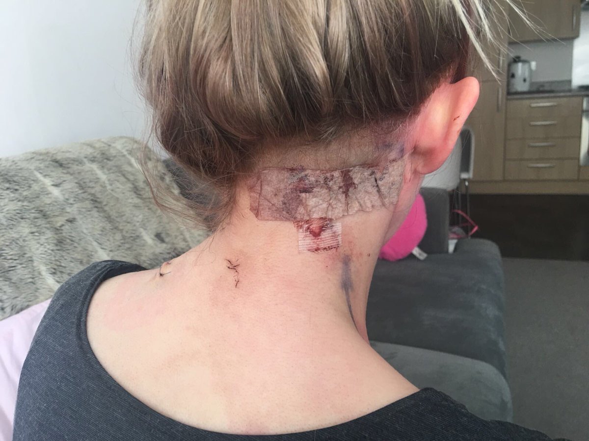 TNadineuk's tweet photo. Tumours removed last week can’t look left or right,time to recover! @hollywills @Schofe @JasonManford @peterandre @jamescordenbae @edsheeran @StephenMulhern @antanddec @Rylan @ThisisDavina @EmmaWillis pretty please 🙏🏻 https://t.co/yEhjrSpXFC