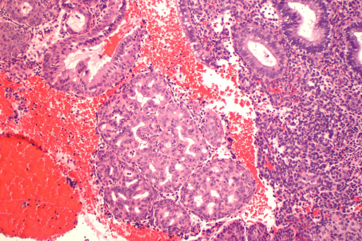 تويتر Ted Farzaneh Md على تويتر Andresangel3 Eosinophilic Syncytial Change Or Metaplasia Papillary Syncytial Metaplasia In Bleeding Endometrium Ki67 Would Be Helpful To Ddx From Atypical Hyperplasia Or Carcinoma