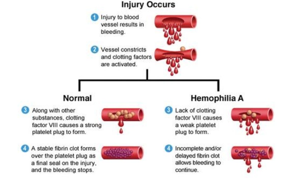sasocp's tweet photo. Anwser2:
The clinical presentation of bleeding in haemophilia depends on the severity of the disease. https://t.co/ShGC9cwqgr