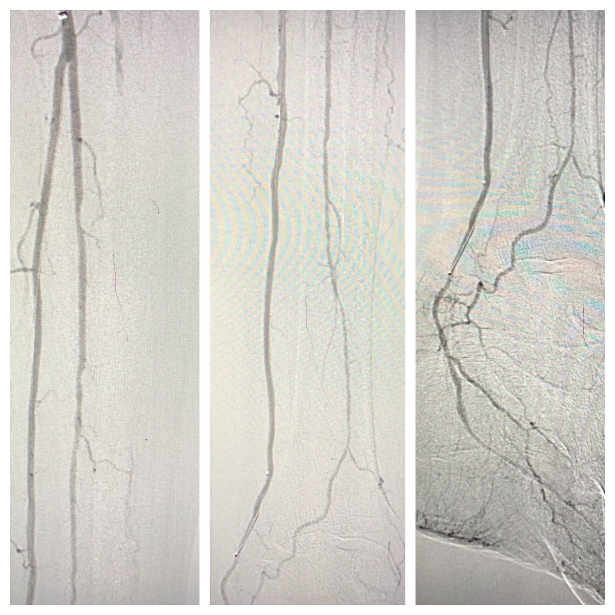 monteromiguel's tweet image. Rest pain, small non healing wound over 2nd toe. Diabetic. W1FI1I3 @hendolat @bsc_pi @BCM_Surgery #Rotablator #CLTI #LimbSalvage