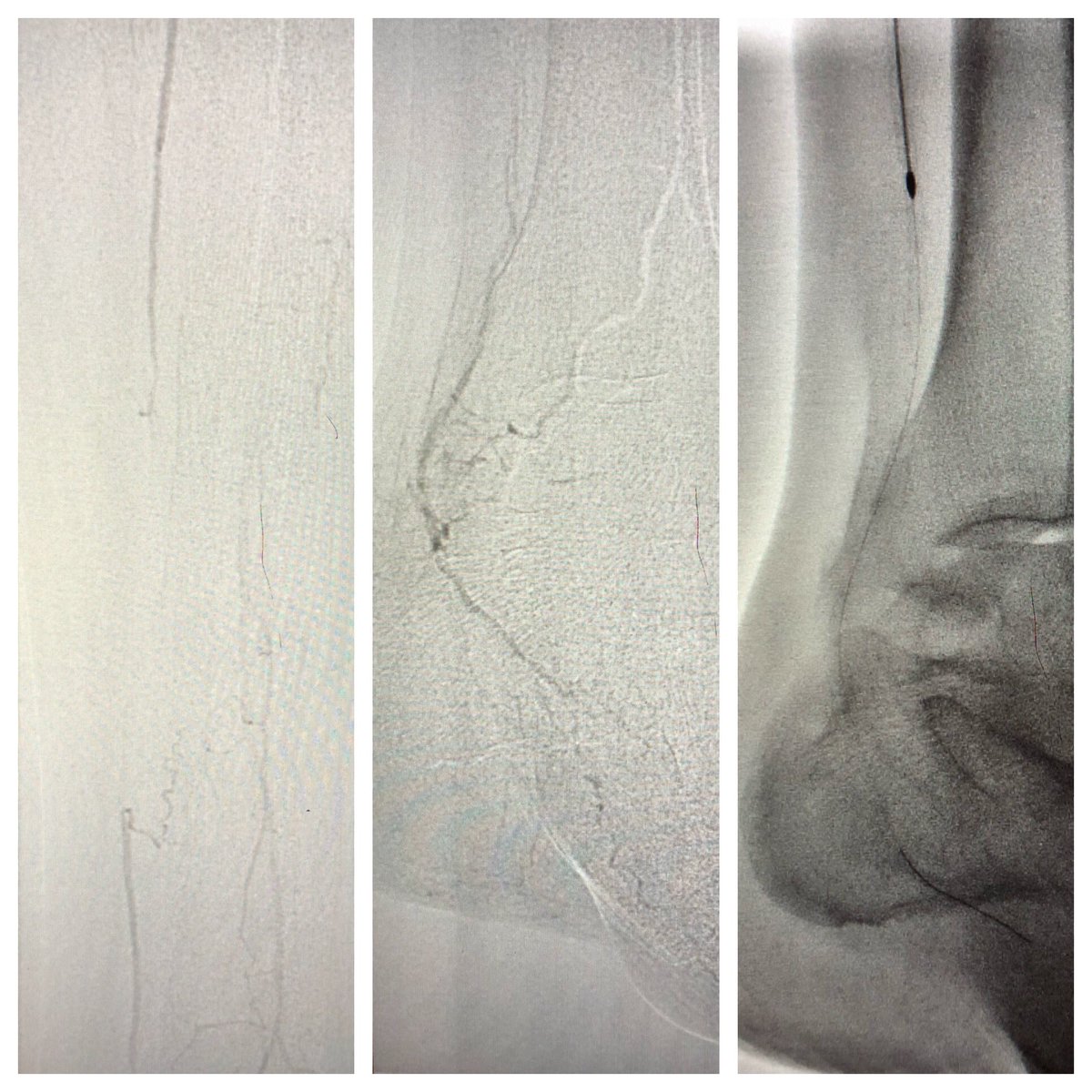 monteromiguel's tweet image. Rest pain, small non healing wound over 2nd toe. Diabetic. W1FI1I3 @hendolat @bsc_pi @BCM_Surgery #Rotablator #CLTI #LimbSalvage