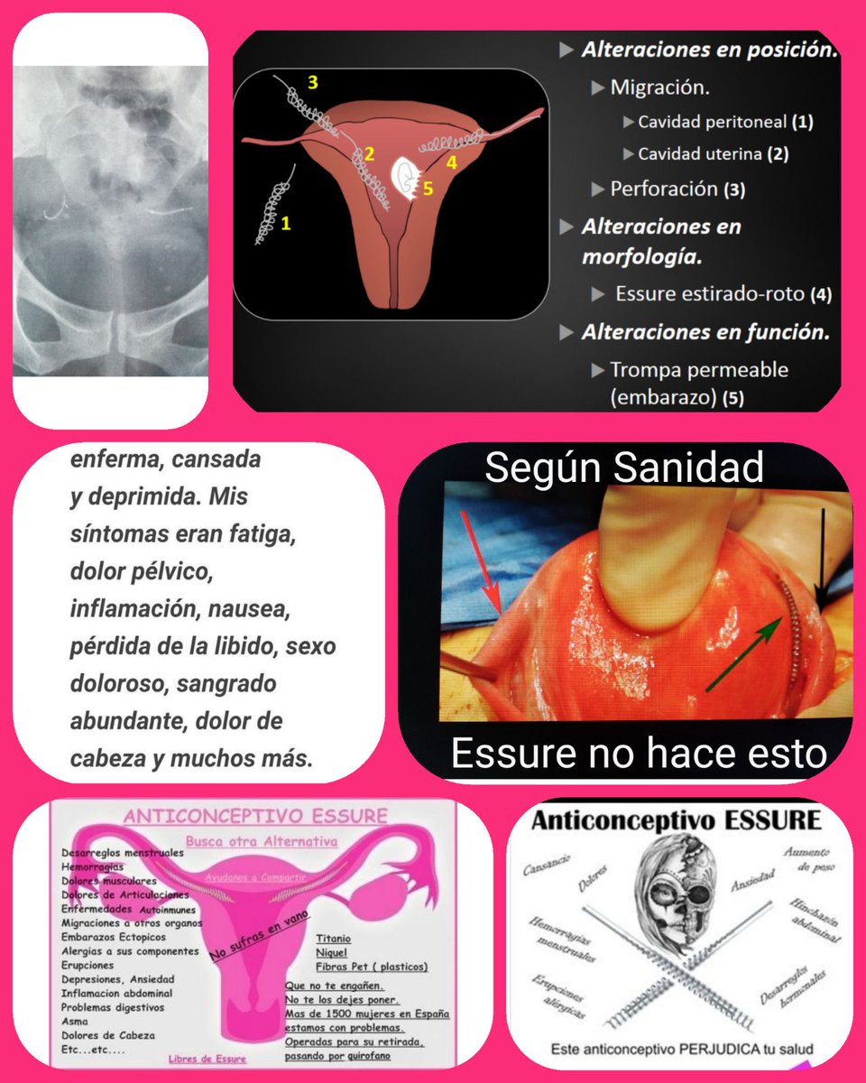 EssureCarol's tweet photo. #Essure 
#ProtocoloEssureYa 
@DolorsMM 
@sanidadgob 
@AEMPSGOB 
@CastrejeA 
@libresdeessure 
@Carmen37066383 
@SVidona 
@Medicina_TV 
@TopDoctors_es 
@Farodevigo 
@DIARIOMEDICO_PE https://t.co/04rB1ejvVl