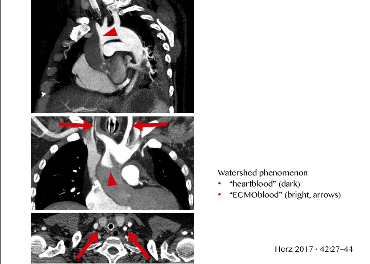 gaozongwei's tweet photo. Upper Body Hypoxia
Two Circulation Syndrome
Harlequin Syndrome
Watershed phenomenon https://t.co/CqVSNSLppu
