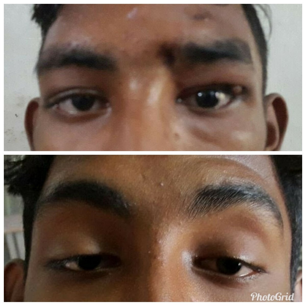 sumitaeyeclinic's tweet photo. #bilateral #severe ptosis #frontalis sling #postop day 3 #Ophthalmology #ophthalmologists #ophthalmologist #cosmeticsurgery #EyeCare #EyeHealth #eye #Vision #VisionCare
19 year old Chetan who suffered from severe drooping of eye lids underwent repair & currently has no issues!!! https://t.co/SqrdqFg8mv