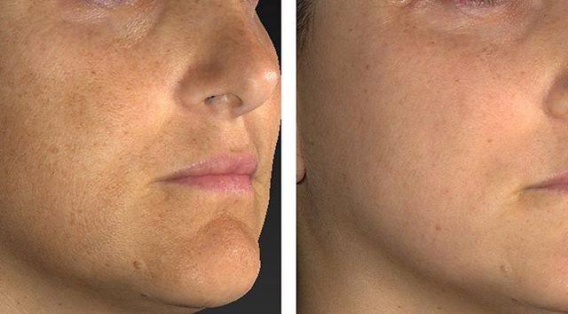 IPL Treatment for pigmentation reduction using our Cynsosure Palomar Icon Laser. Clearer skin is younger looking skin <a href="/drjoneydesouza/">Dr Joney De Souza</a> <a href="/cynosureuk/">Cynosure Consulting</a> <a href="/wigmoremedical/">Wigmore Medical</a> #cynosure #palomaricon #ipl #ipltreatment #pigmentation #pigmentationreduction #aestheticdoctor #laserclinic