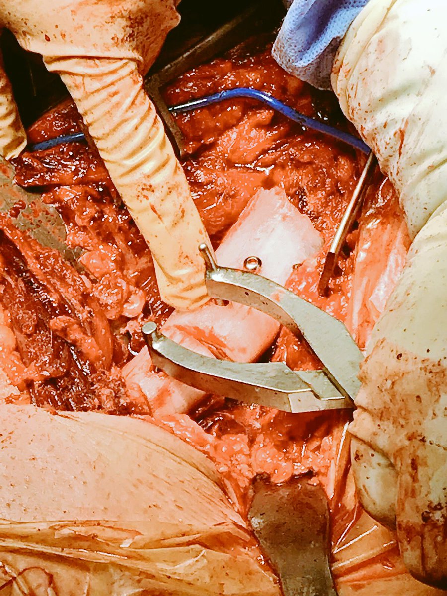 rupermac's tweet photo. Intraoperative images during femoral osteotomy and intramedullary preparation after correcting the deformity. https://t.co/crutq2yWdc