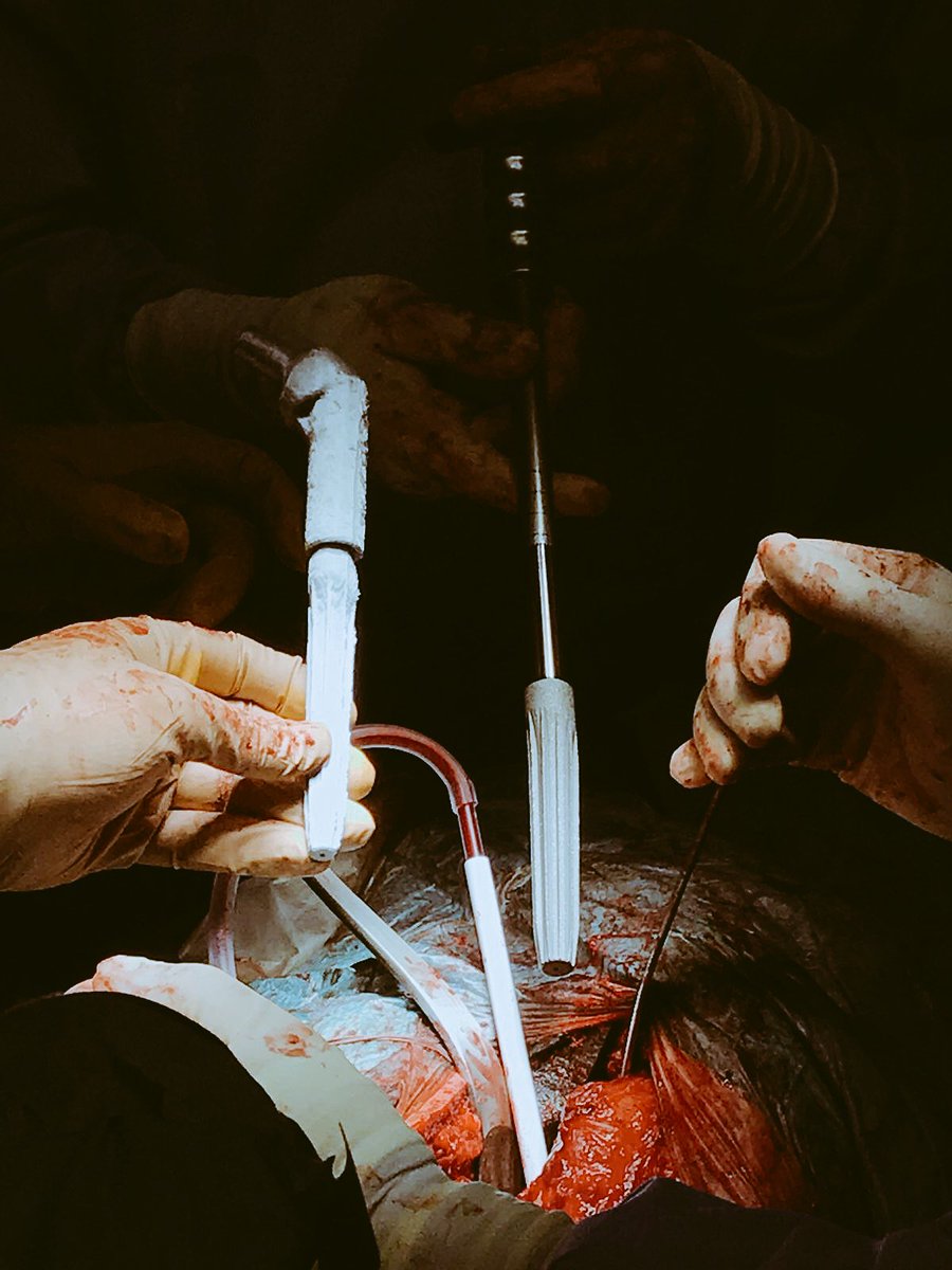 rupermac's tweet photo. Intraoperative images during femoral osteotomy and intramedullary preparation after correcting the deformity. https://t.co/crutq2yWdc