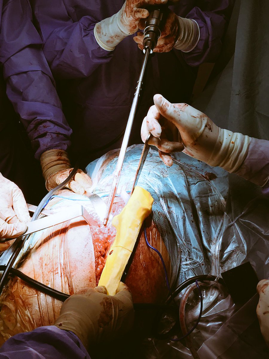 rupermac's tweet photo. Intraoperative images during femoral osteotomy and intramedullary preparation after correcting the deformity. https://t.co/crutq2yWdc