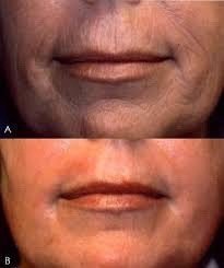 HealingBeautyC's tweet photo. Plasma Pro Skin Tightening is known for its success with Non Surgical Eye lift, Skin Tag Removal, Tummy Tightening, Stretch Marks and so much more. 

Book a consultation today: 519-653-1991 reception@healingbeautyclinic.com 

#plasmaskintightening #clinic #fibroblast #skin https://t.co/9aOAGrxAHc