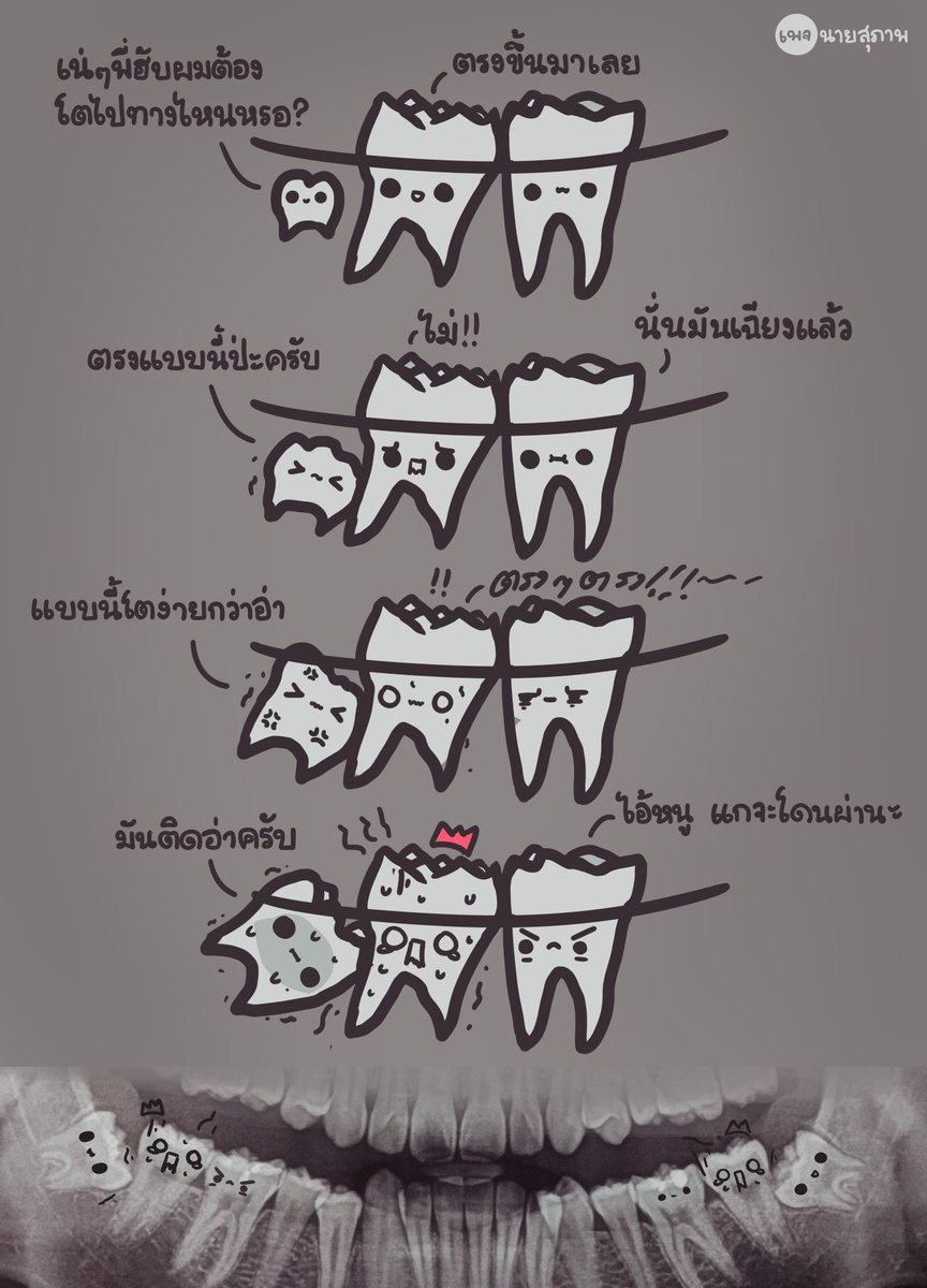 ninesupap's tweet image. บางทีเราก็ควรเชื่อคนอื่นนะครับ 555 // 2 ข้างเลยอ่ะ #ฟันคุด