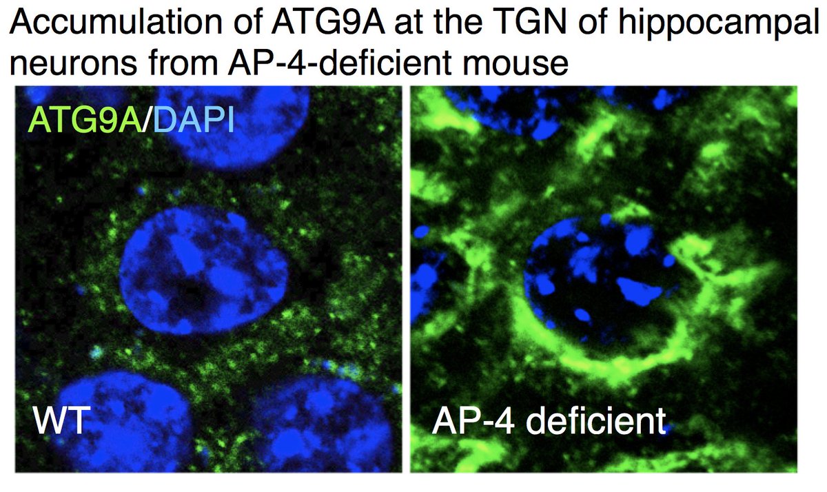 Juan S. Bonifacino (@bonifacinojuan) on Twitter photo Our latest paper showing ATG9A missorting and axonal dystrophy in neurons from a mouse model of AP-4-deficiency syndrome, a form of hereditary spastic paraplegia, is available <a href="/PLOSGenetics/">PLOS Genetics</a> tinyurl.com/yag3yu6y Relevant to @CureSPG47 <a href="/AutophagyPapers/">Autophagy Papers</a> @NICHD_NIH Our latest paper showing ATG9A missorting and axonal dystrophy in neurons from a mouse model of AP-4-deficiency syndrome, a form of hereditary spastic paraplegia, is available <a href="/PLOSGenetics/">PLOS Genetics</a> tinyurl.com/yag3yu6y Relevant to @CureSPG47 <a href="/AutophagyPapers/">Autophagy Papers</a> @NICHD_NIH