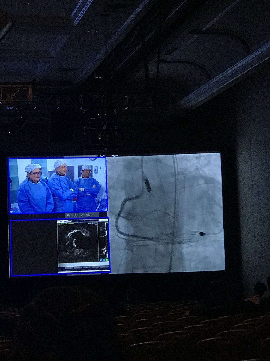 jjmt_heartrecov's tweet image. Happening now at #SCAI18 a Protected PCI live case with hemodynamic support from #Impella from @NorthwellHealth