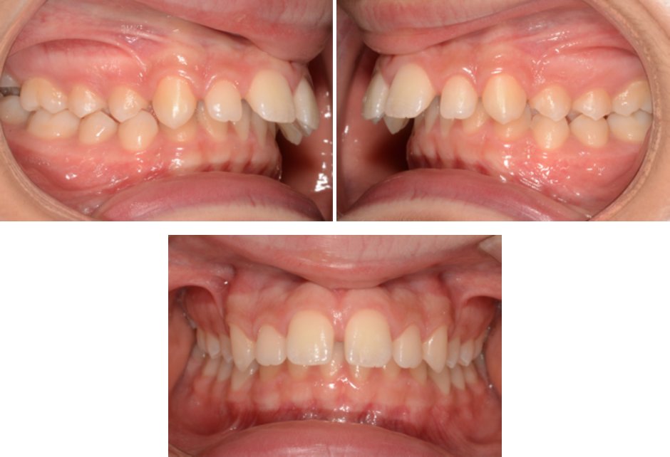 DS_Ortho's tweet photo. Today's #CCOSystem Case File: Dr. Raffaele Spena shares his detailed treatment plan and results for a 12 year old thumb and lower lip sucker. https://t.co/7CarjZkjmh https://t.co/5PPQPj7Y3z