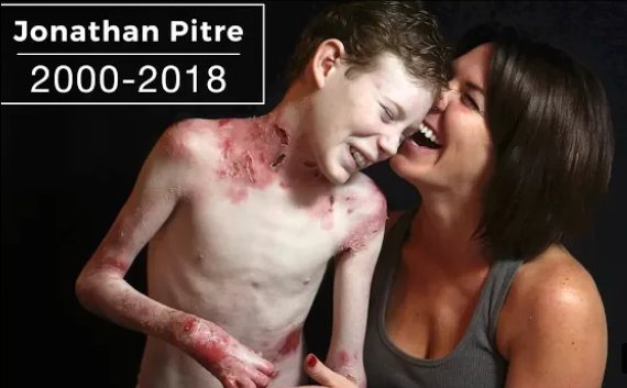 jeanobluejeans's tweet image. #RIPJonathan the butterfly boy 😥