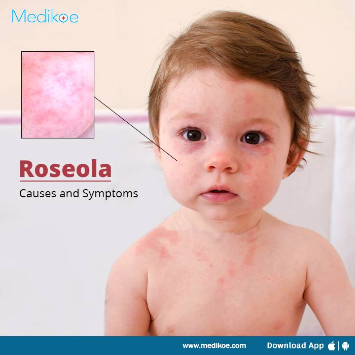 Medikoe On Twitter Roseola Is A Viral Illness That Commonly Affects