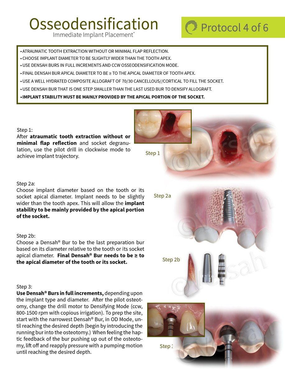 VersahLLC's tweet photo. Protocol 4 of 6 - Osseodensification Immediate Implant Placement. 2 More protocols to come - Stay tuned! #Versah #Densah https://t.co/x6Ko9Ef4JR