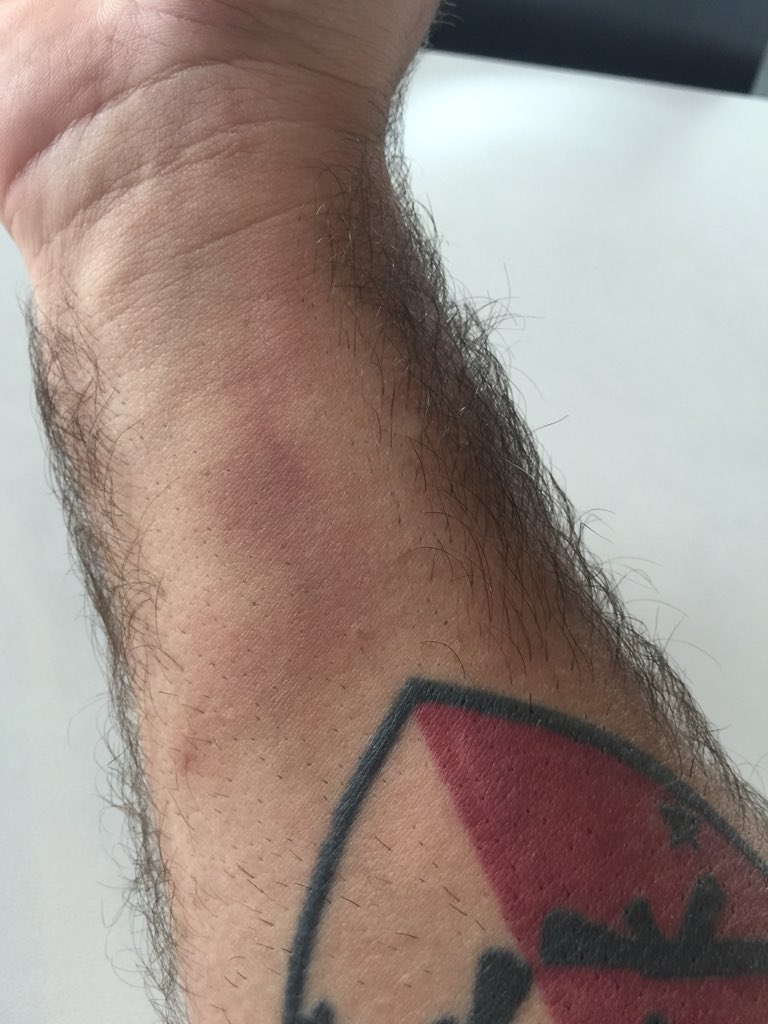 UltraAk's tweet image. Ich glaube ich wurde beim Rugby 🏉 spielen gebissen