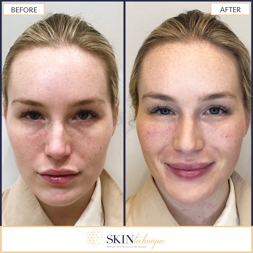 under eye filler before and after under eye filler before and after