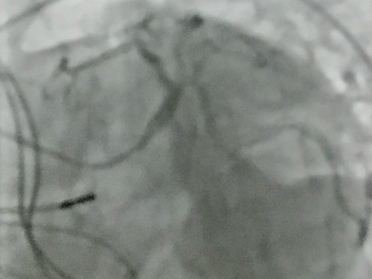 DrSethdb's tweet image. #SCAI18
Ehtisham Mahmud @UCSDHealth does live case of MVD including left main LVEF=30% with #Impella support 
#ProtectedPCI
