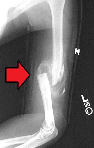 EColi_official's tweet photo. @_B_Mega_ @1thefunnybone1 Get wrecked. Simple complete displaced spiral transverse fracture. https://t.co/M5oXgIjNbh
