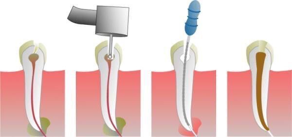 OdontologoSpain's tweet photo. #ALosPacientes: cuando el nervio del diente se afecta tras una #caries, se aconseja matar el nervio (#Endodoncia). https://t.co/jfEyux9HBZ