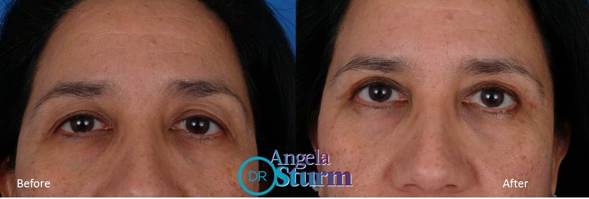 DrAngelaSturm's tweet photo. Before and after upper eyelid surgery to open the eyes, give a more refreshed look and make the lids less heavy with minimal downtime! https://t.co/j8ubZCHx9f