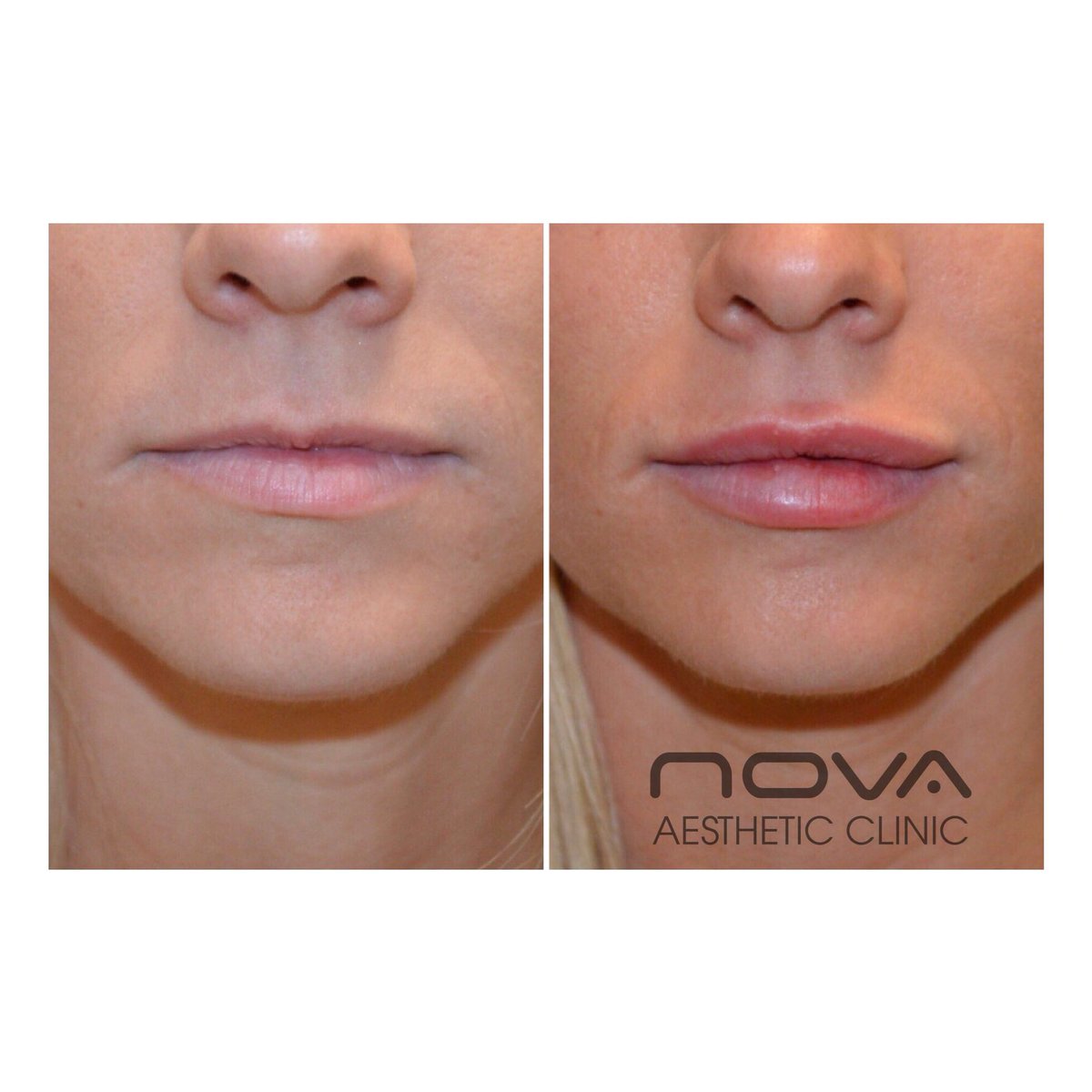 💥LIP FILLER OFFER at Nova💥 £195 instead of £250 for half ml of lip filler!Limited space available. Booking must be made and deposit paid before THIS SATURDAY 12 May, but treatment can be carried out within one month. Full T&amp;Cs on our Instagram 👌🏼 #Greenwich #lipfiller #beauty