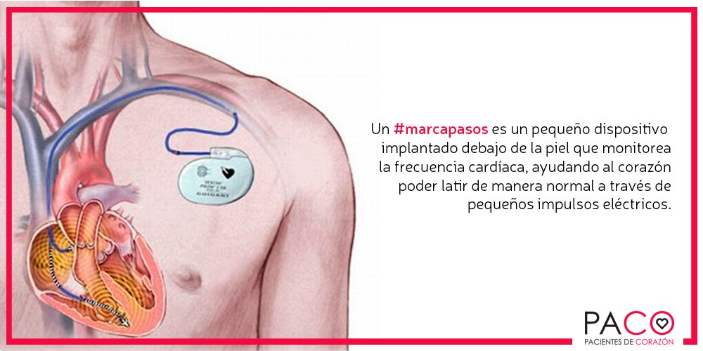 PACO_Asociacion's tweet photo. Un #marcapasos es un pequeño dispositivo 
implantado debajo de la piel que monitorea
la frecuencia cardíaca, ayudando al corazón
poder latir de manera normal a través de
pequeños impulsos eléctricos. https://t.co/bff0L4jCeQ