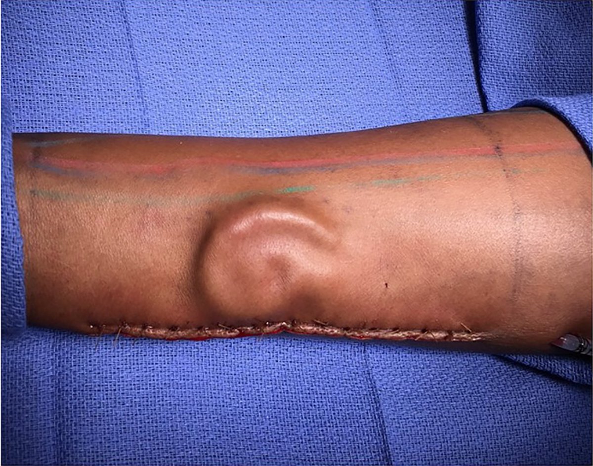 LiveScience's tweet photo. How Did This Soldier 'Grow' an Ear on Her Forearm? https://t.co/lTpWnUxVMH https://t.co/gkq6JhNKvk