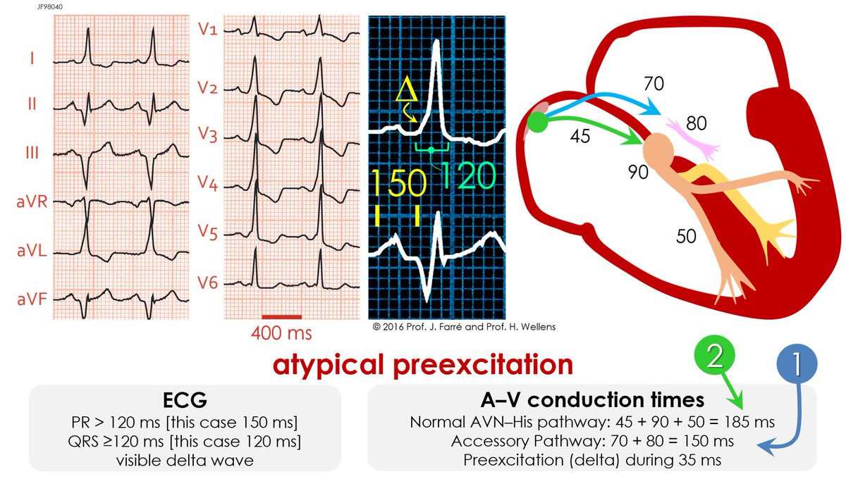 ECGcorner's tweet photo. Atypical #preexcitation
https://t.co/gMuwGUYYw1
#electrocardiography #ECGlovers #FOAMed #ECG https://t.co/lt1bFAXObw