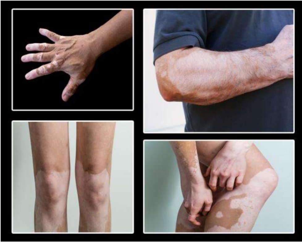 PharosLaser's tweet image. #Leukoderma is #depigmentation of skin (white patches) marked by localization or destruction of #melanocytes. The #ProgressiveSkinDisorder is called #vitiligo when the condition occurs without any previously associated disease that can be linked with the onset of the condition.