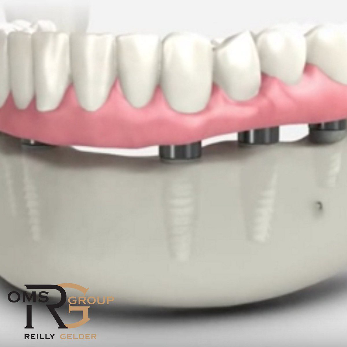 ReillyGelderOMS's tweet photo. Over time, patients with missing teeth encounter loss of jawbone. #BoneGrafting treats bone loss &amp; allows for appropriate, secure dental implant placement. We provide bone grafting, #SinusGrafts &amp; #SinusBumps. #DentalImplants: https://t.co/d2l3aFYcKq https://t.co/Nv0wzyF6pL