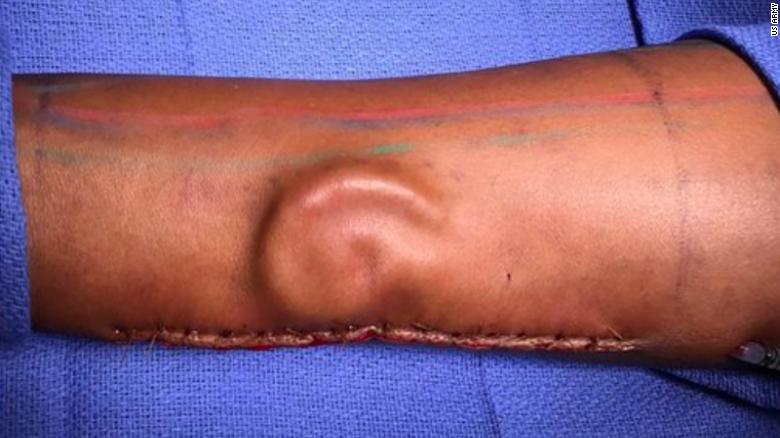 CNN's tweet photo. A soldier lost her ear in a car accident. So doctors grew her a new one -- on her forearm https://t.co/siJgcnQkp1 https://t.co/USlfZgLkc9