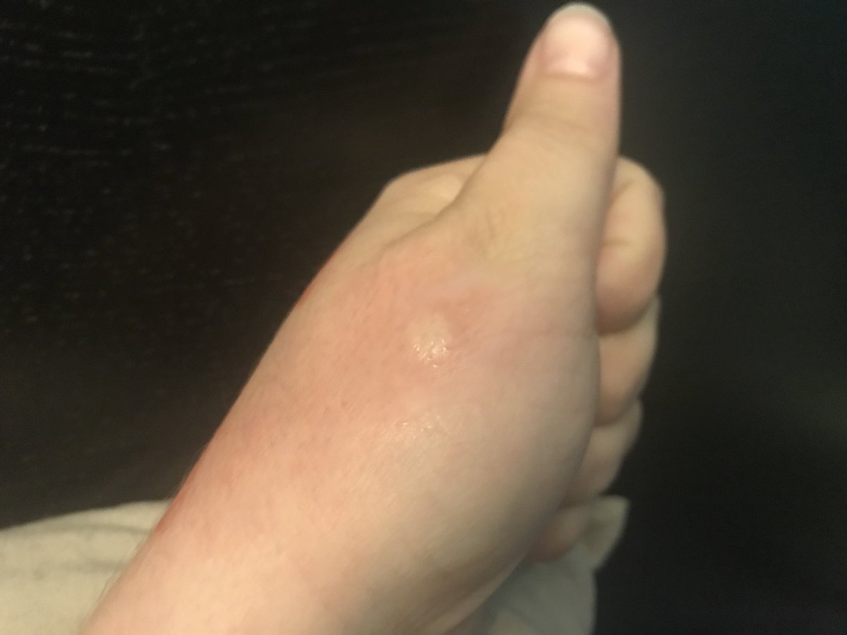 il_largia's tweet photo. Demà em desperto a les 6. porto dos hores caçant mosquits. M’han picat al cul, a la cama i a la mà. Són mosquits tigre. #prayformandy https://t.co/mfLThyATKD