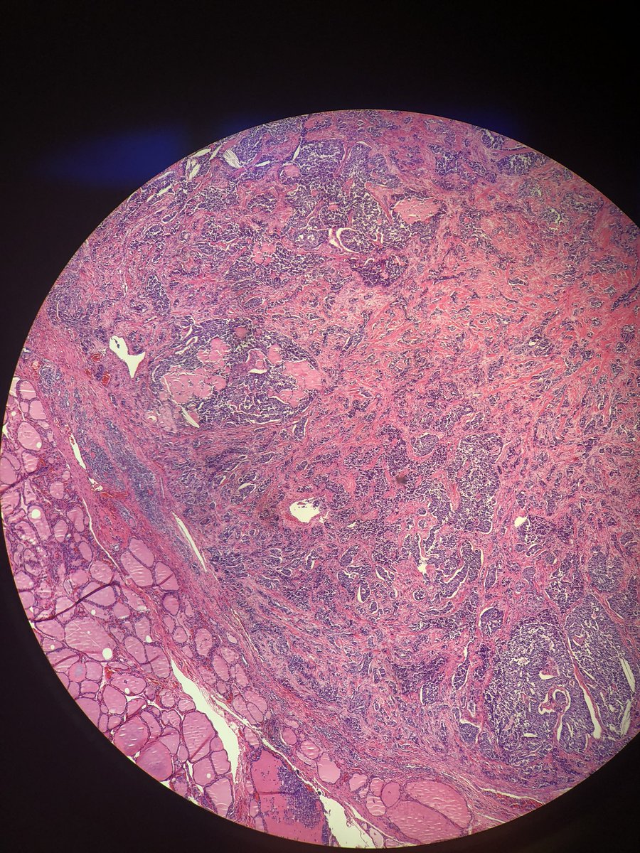 Neuygn's tweet photo. Beautiful case of thyroid carcinoma with “Apple-green” birefringence! @BaptistHealthSF @TheEstherCheng @Pathologista #thyroid #pathart #pathology https://t.co/A88y9i9zsp