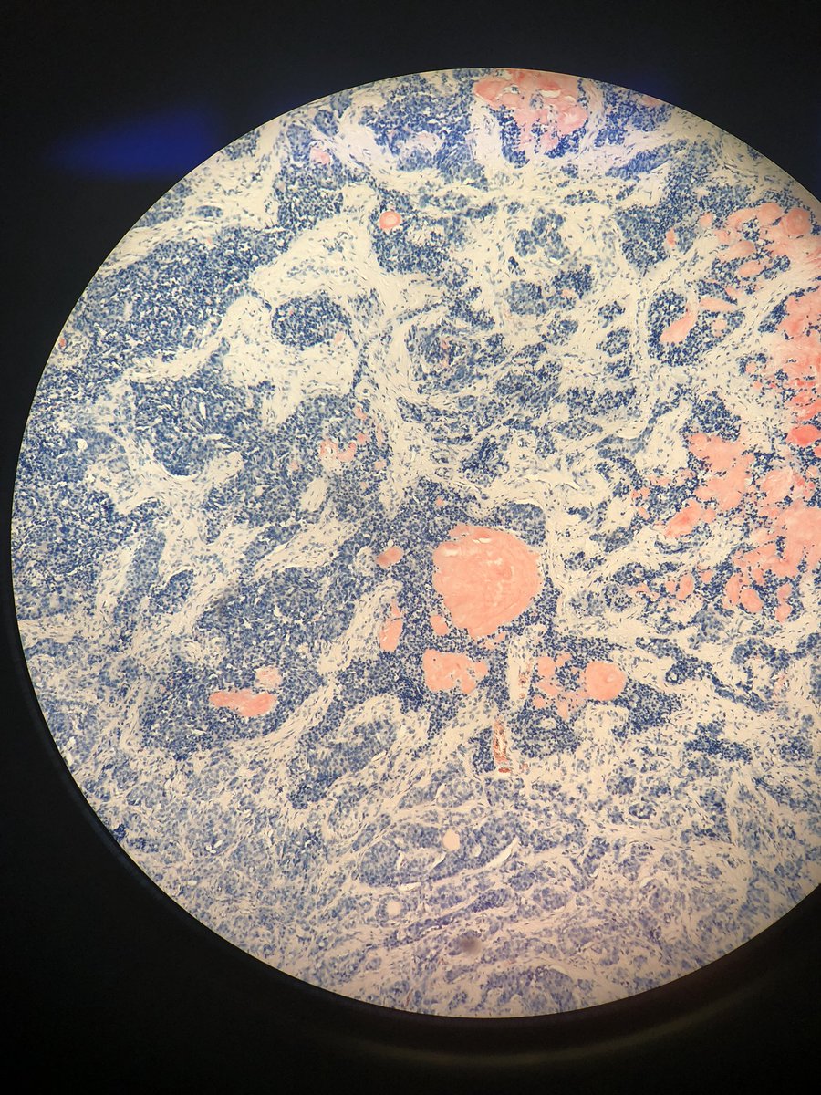 Neuygn's tweet photo. Beautiful case of thyroid carcinoma with “Apple-green” birefringence! @BaptistHealthSF @TheEstherCheng @Pathologista #thyroid #pathart #pathology https://t.co/A88y9i9zsp