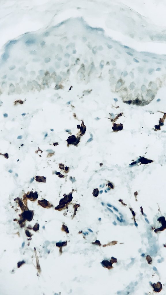 LizaAriasT's tweet photo. Even when you know they are there... you need to double check! #mastocytes #CutaneousMastocytosis #CD117 #DermPath #Dermatopathology #LovingDermPath  #Dermatopathologist https://t.co/JO5ZQodOuj
